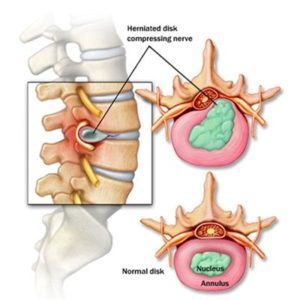 Phòng ngừa và điều trị thoát vị đĩa đệm bằng xà đơn xếp Khánh Trình